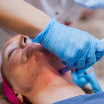 Microneedling Classic