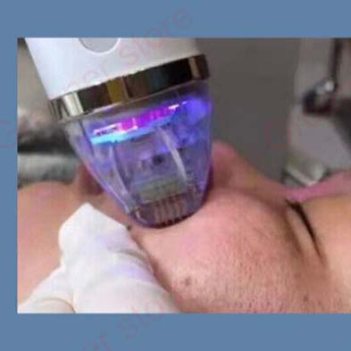 RF Radiofrequenziertes Microneedling